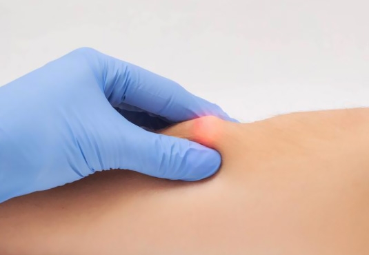 Şişli'de Yağ Bezesi Ameliyatı